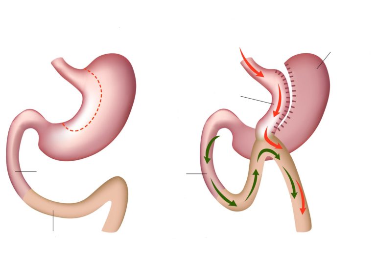 Mini - Gastric Bypass Surgery or single anastomosis gastric bypass